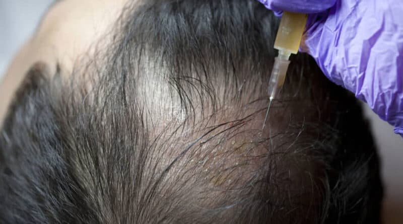 PRP Treatment For New Hair Growth